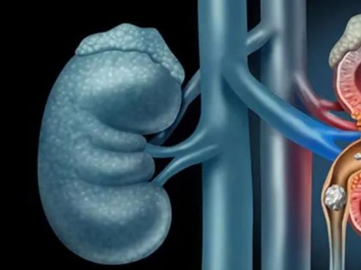 urologist-001 urinary stones